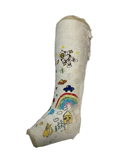 Plaster Half leg cast