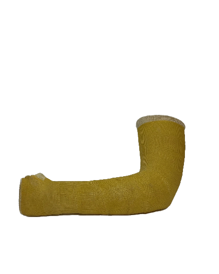 Fibreglass Arm Cast (Left)