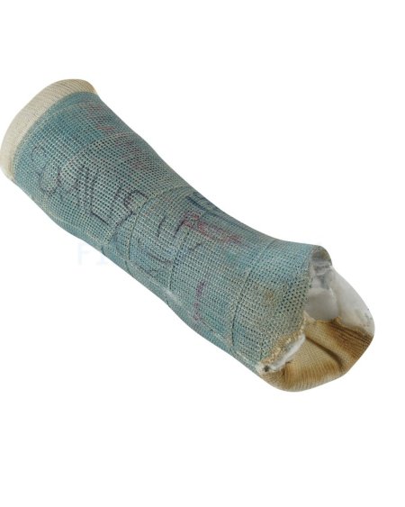 Cast Childs Arm