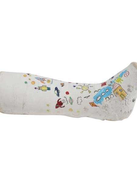 Leg Cast 