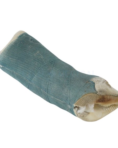 Half Arm Cast