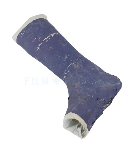 Painted Leg Cast