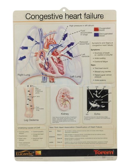 Congestive Heart Failure Poster 3D