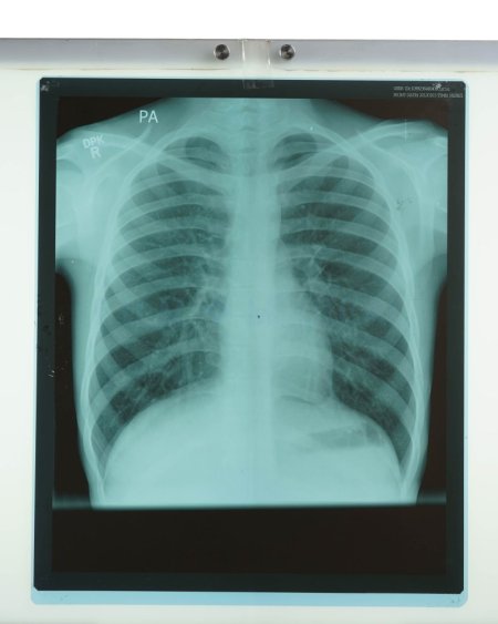 X-Ray Chest