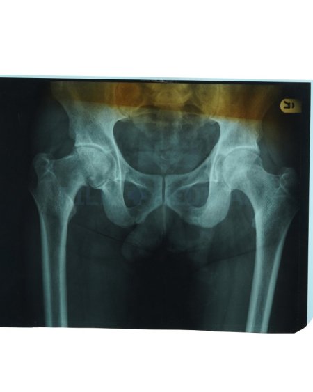 X-Ray Pelvis