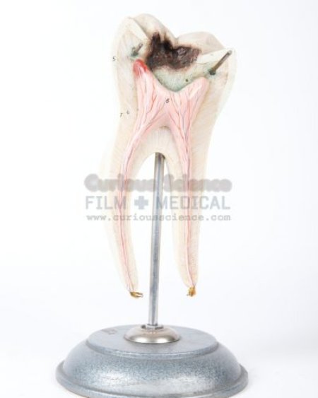 Model of decayed tooth