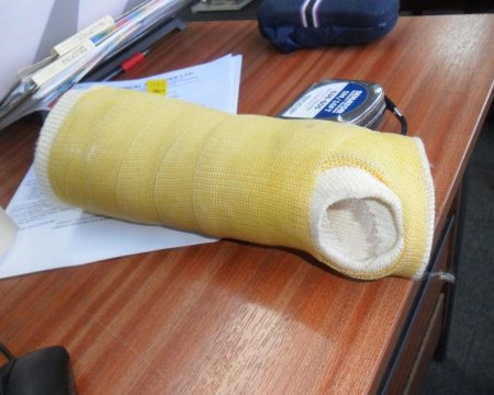 Plaster arm cast
